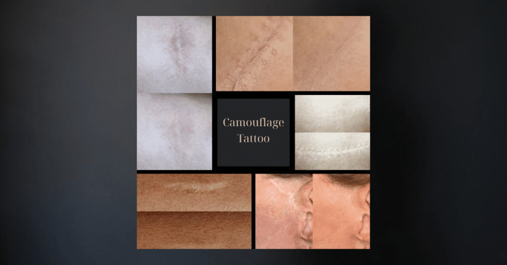 Κάλυψη ουλής με τεχνική Camouflage Tattoo