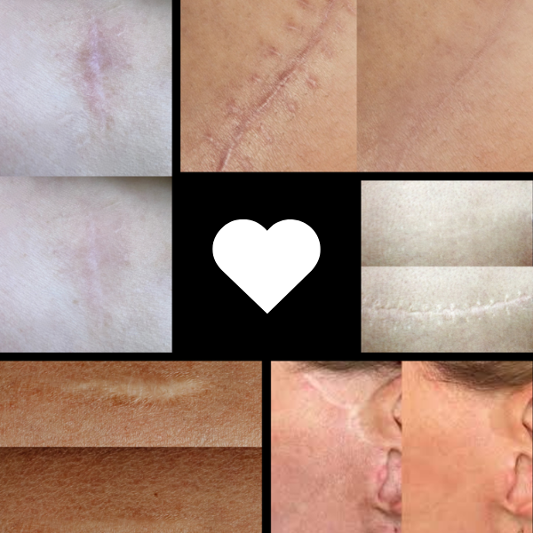 Ανώνυμο-500-x-571-px-500-x-500-px-600-x-600-px-1 Dry Tattoo